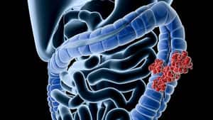 Need HER2+ Testing in CRC; Trastuzumab Deruxtecan Shows Benefit