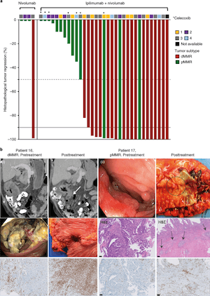 Neoadjuvant immunotherapy leads to pathological responses in MMR-proficient and MMR-deficient early-stage colon cancers