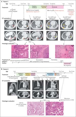 Vaginal Transmission of Cancer from Mothers with Cervical Cancer to Infants | NEJM